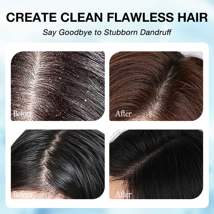 1% Ketoconazole Anti-Dandruff Oil Control Shampoo